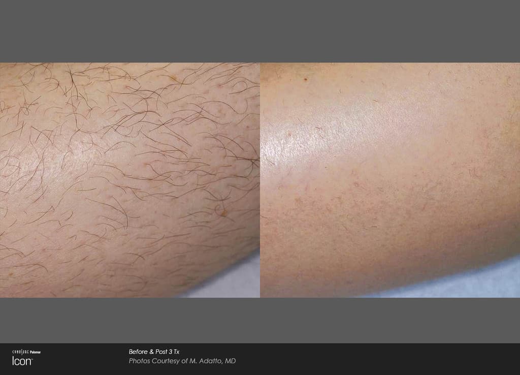 Permanent Laser Hair Removal Newport Medical And Wellness Center