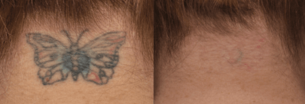 Tattoo Removal at Newport Medical and Wellness
