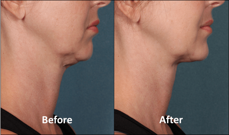 Kybella Before And After Photos Newport Medical And Wellness