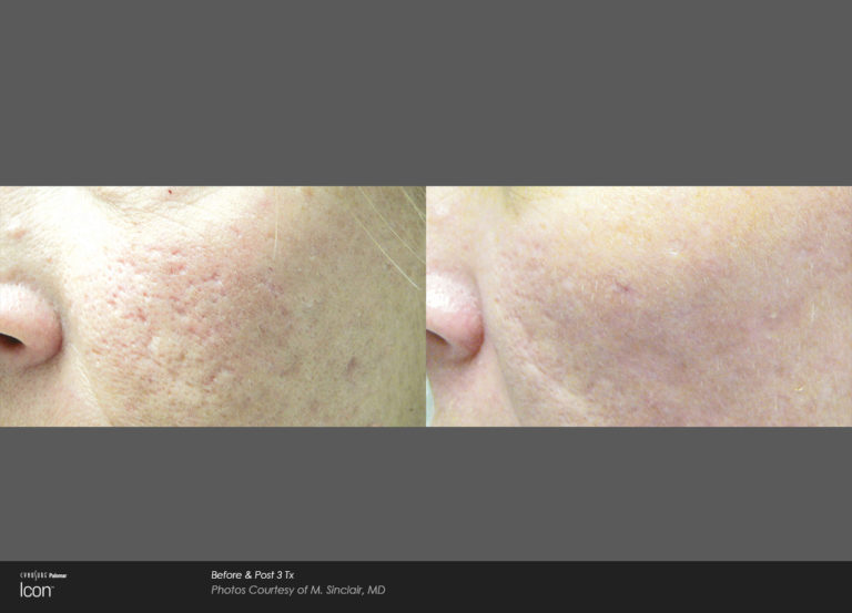 1540 Laser Skin Rejuvenation Newport Medical and Wellness Center
