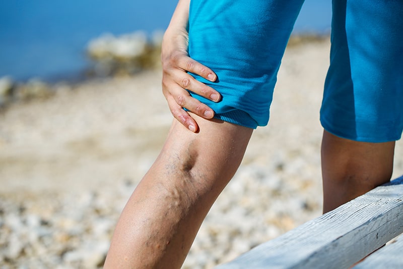What You Should Know About Varicose Vein Treatment | Newport Medical and Wellness