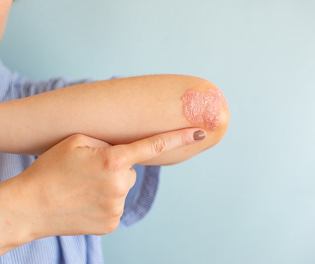 How To Get Involved With Psoriasis Awareness Month | Newport Medical and Wellness Center